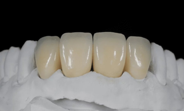 Zirconia Crown & Bridge Full